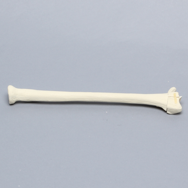 Radius with Distal Five-Part Intra-Articular Fracture, Foam Cortical
