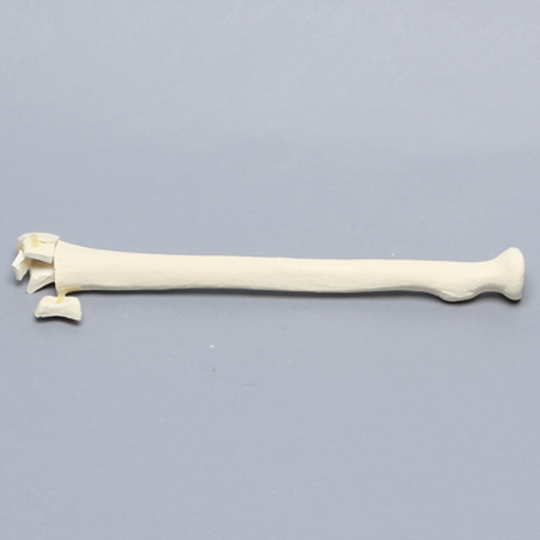Radius with Distal Five-Part Intra-Articular Fracture, Foam Cortical