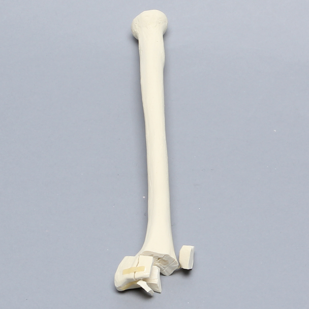 Radius with Distal Five-Part Intra-Articular Fracture, Foam Cortical