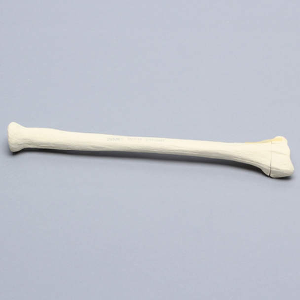 Radius with Transverse Fracture and Fragment, Foam Cortical