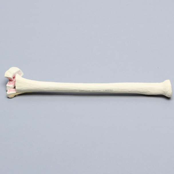Radius with Transverse Fracture and Fragment, Foam Cortical