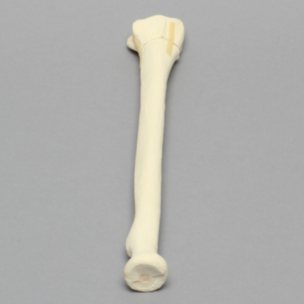 Radius with Transverse Fracture, Foam Cortical