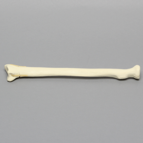 Radius with Transverse Fracture, Foam Cortical