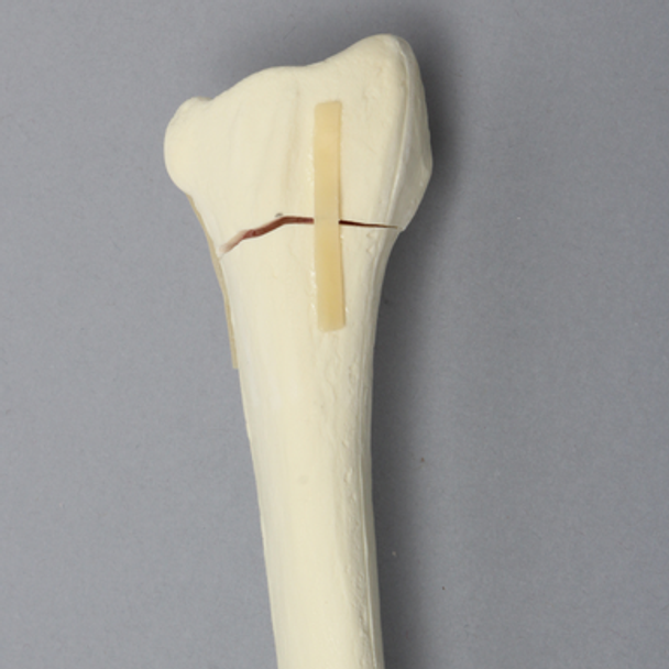 Radius with Transverse Fracture, Foam Cortical
