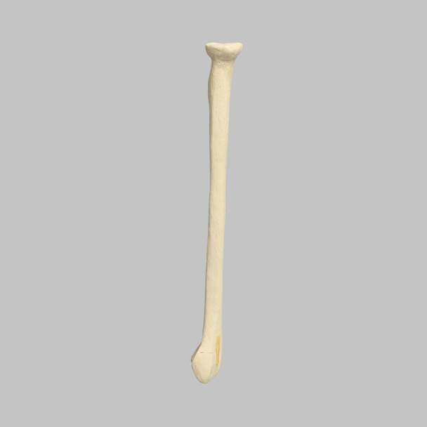 Radius with Transverse Fracture, Foam Cortical