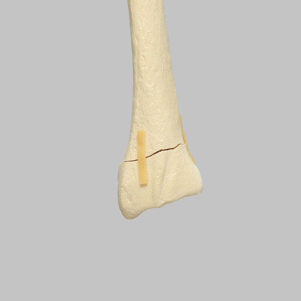 Radius with Transverse Fracture, Foam Cortical