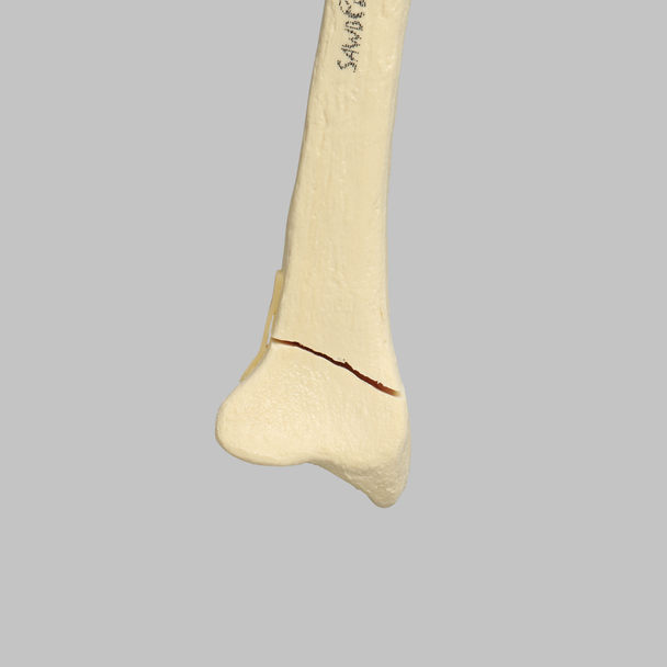 Radius with Transverse Fracture, Foam Cortical