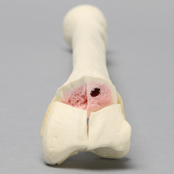 Radius with "Y" Fracture, Foam Cortical