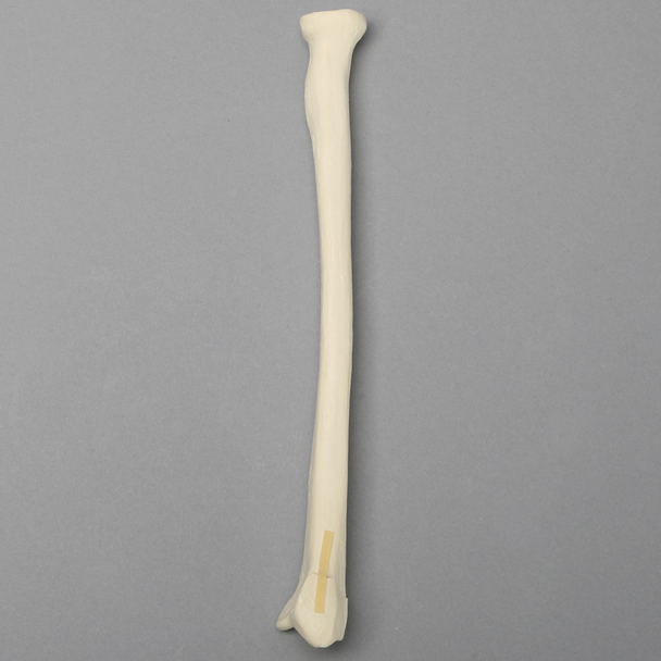 Radius with "Y" Fracture, Foam Cortical