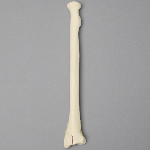 Radius with "Y" Fracture, Foam Cortical