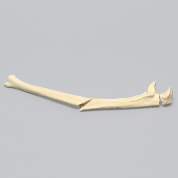 Ulna with Oblique and Transverse Fractures, Foam Cortical