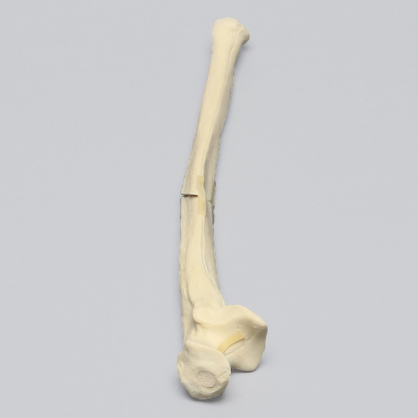 Ulna with Oblique and Transverse Fractures, Foam Cortical