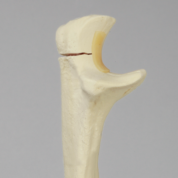 Ulna with Olecranon Fracture for Wire Tension Banding, Foam Cortical