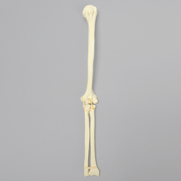 Elbow with Lateral Humeral Condyle Fracture, Foam Cortical