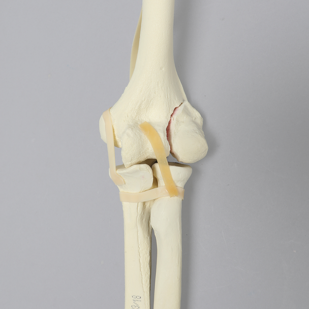 Elbow with Lateral Humeral Condyle Fracture, Foam Cortical