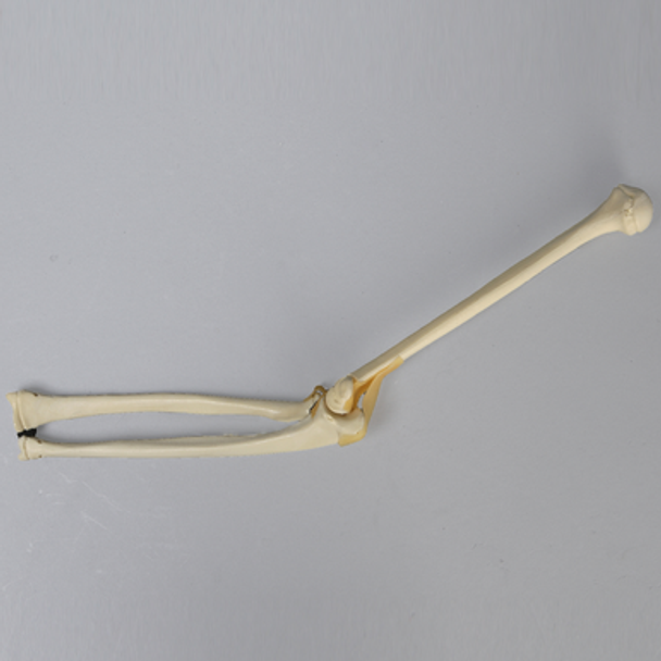 Elbow with Distal Fracture, Pediatric, Solid Foam