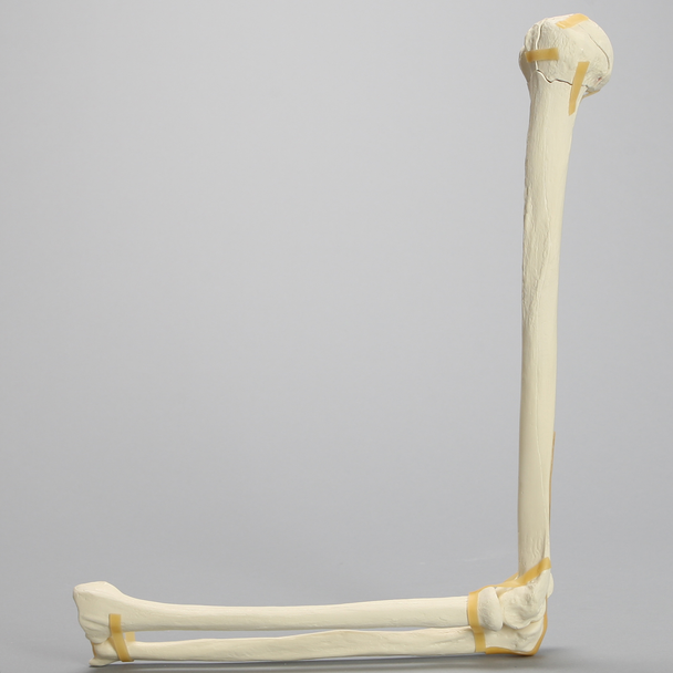 Elbow with Four-Part Fracture, Foam Cortical
