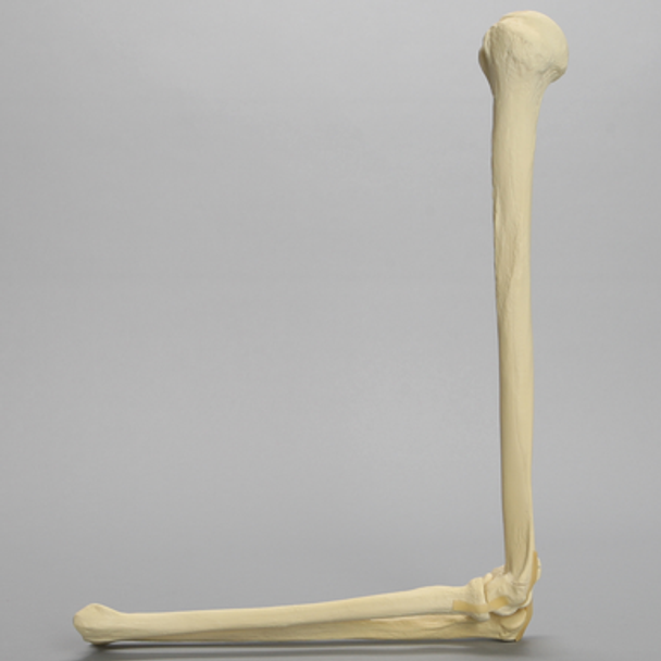 Elbow with Transverse Fracture, Foam Cortical