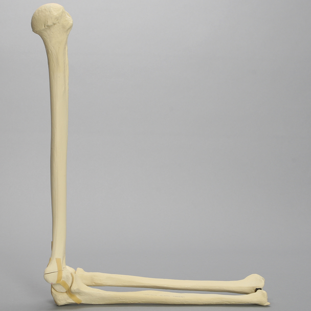 Elbow with Transverse Fracture, Foam Cortical