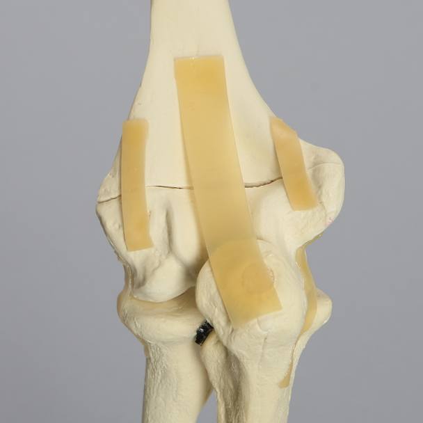 Elbow with Transverse Fracture, Foam Cortical