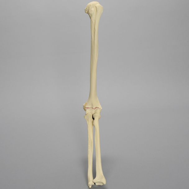 Elbow with Transverse Fracture, Foam Cortical