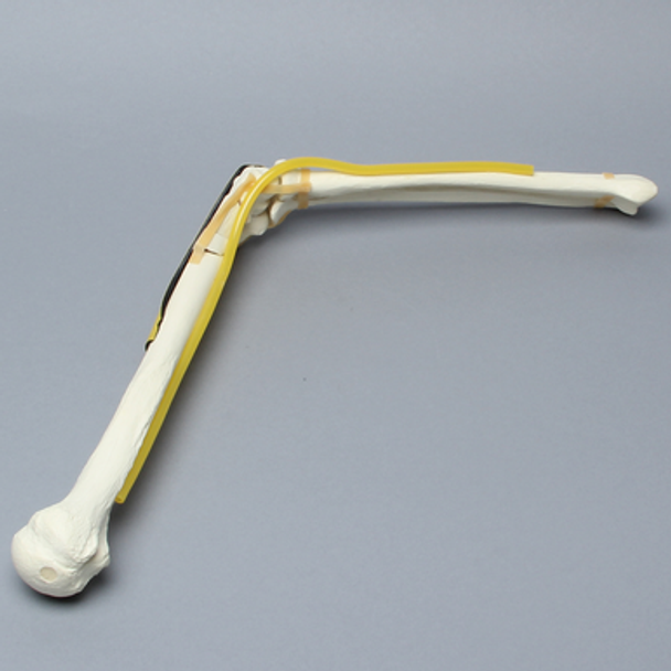 Elbow with Six-Part Fracture, Nerve, and Tendon, Foam Cortical
