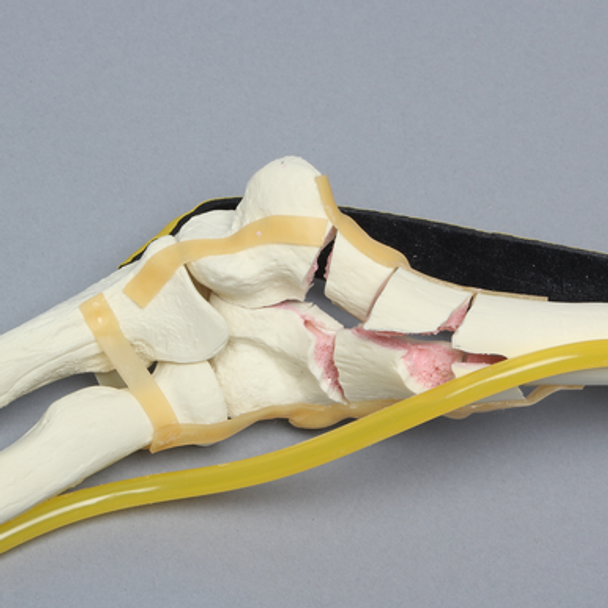 Elbow with Six-Part Fracture, Nerve, and Tendon, Foam Cortical