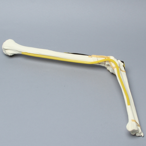 Elbow with Six-Part Fracture, Nerve, and Tendon, Foam Cortical