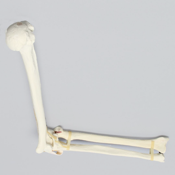 Elbow with Radial Head and Coronid Fractures and Severed Ligament, Foam Cortical
