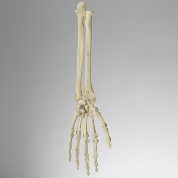 Hand and Wrist with Three-Part Fracture, Foam Cortical