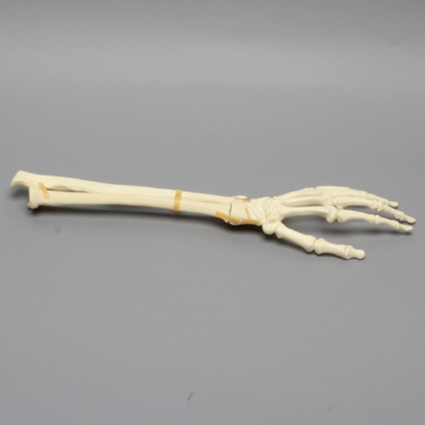 Hand and Wrist with Four-Part Fracture, Foam Cortical
