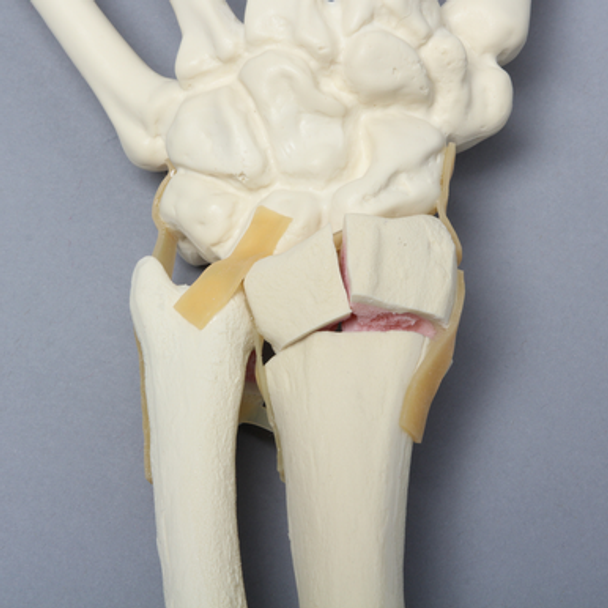 Hand and Wrist with Four-Part Fracture, Foam Cortical