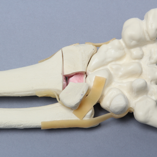 Hand and Wrist with Four-Part Fracture, Foam Cortical