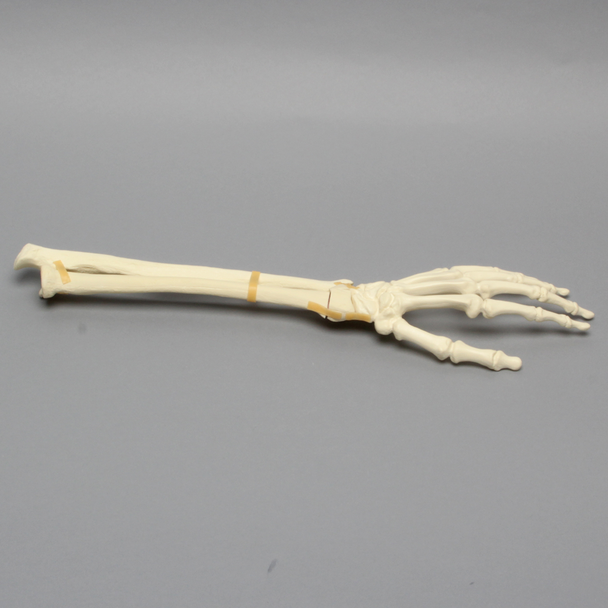 Hand and Wrist with Four-Part Fracture, Foam Cortical