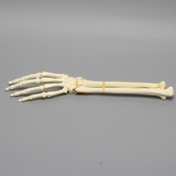 Hand and Wrist with Four-Part Fracture, Foam Cortical
