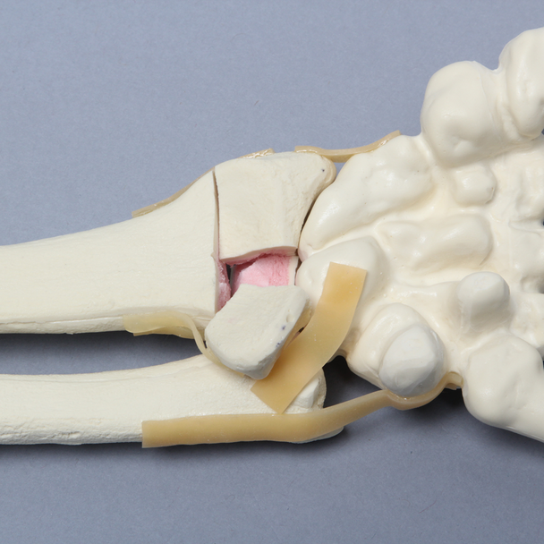 Hand and Wrist with Four-Part Fracture, Foam Cortical