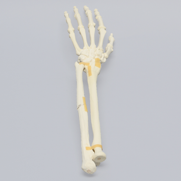 Hand and Wrist with Oblique and Colles' Fractures, Solid Foam