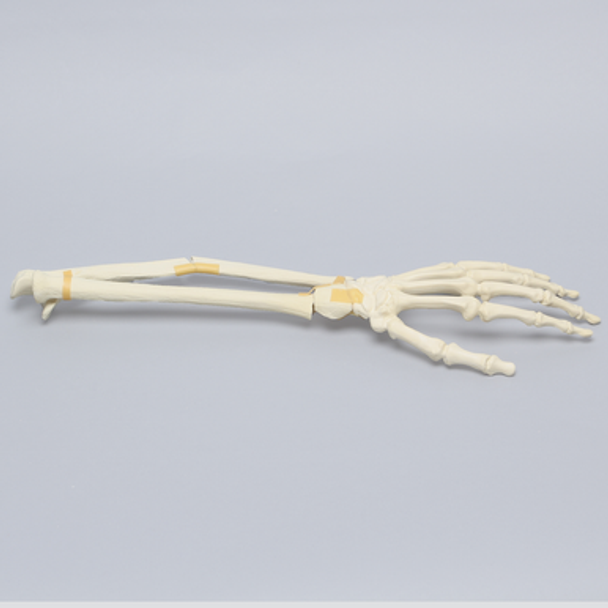 Hand and Wrist with Oblique and Colles' Fractures, Solid Foam