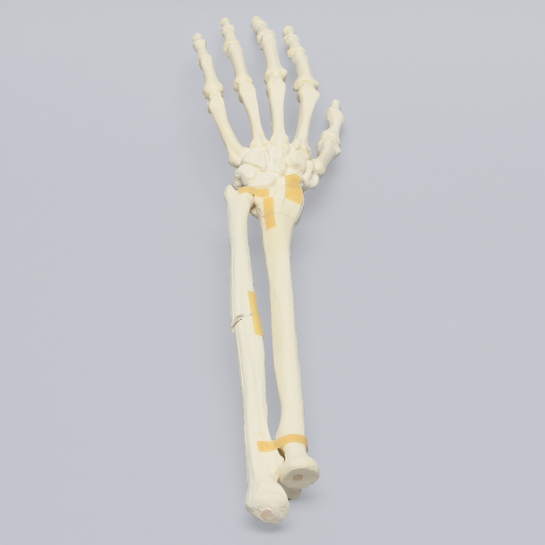 Hand and Wrist with Oblique and Colles' Fractures, Solid Foam