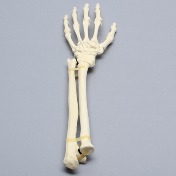Hand and Wrist with Colles' Fracture, Solid Foam