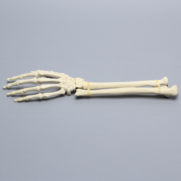 Hand and Wrist with Colles' Fracture, Solid Foam