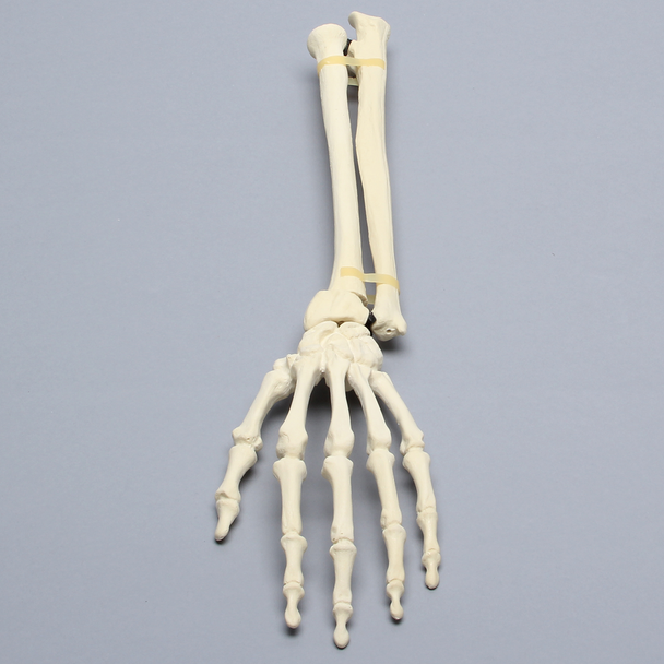 Hand and Wrist with Colles' Fracture, Solid Foam