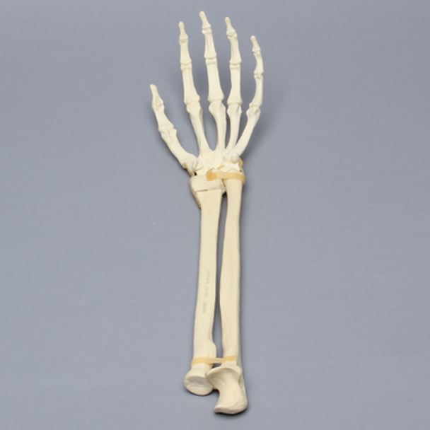 Hand and Wrist with Transverse Radial Fracture, Solid Foam