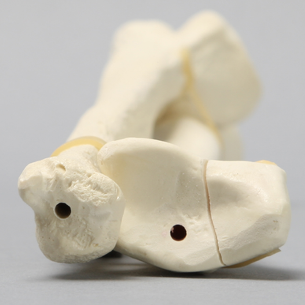 Ulna and Radius with Styloid Fracture, Foam Cortical