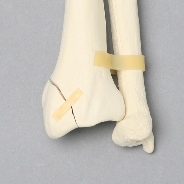 Ulna and Radius with Styloid Fracture, Foam Cortical