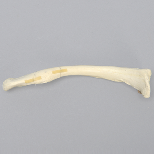 Clavicle with Butterfly Fracture, Solid Foam