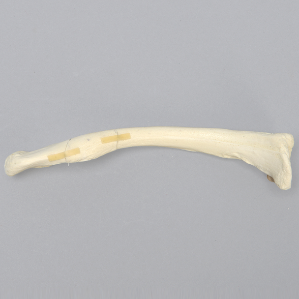 Clavicle with Butterfly Fracture, Solid Foam