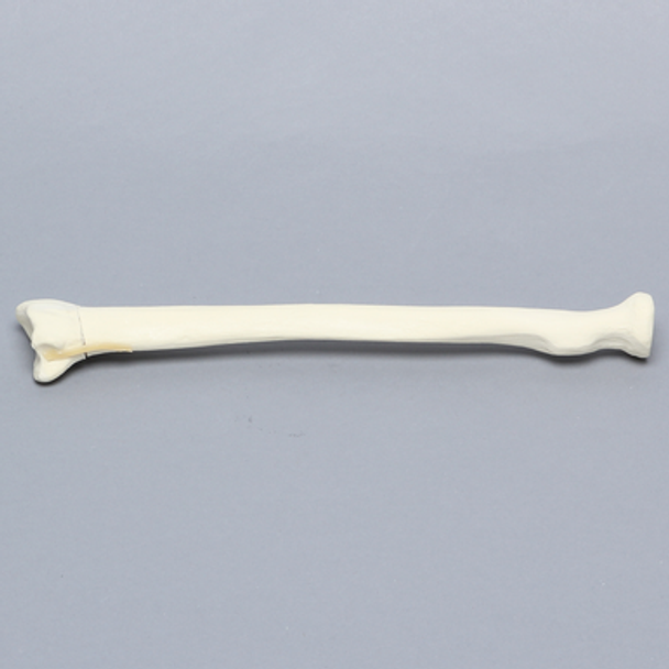 Radius with Transverse Colles' Fracture and Removed Tubercle, Foam Cortical