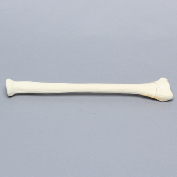 Radius with Transverse Colles' Fracture and Removed Tubercle, Foam Cortical