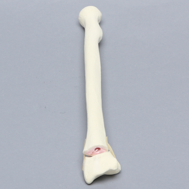 Radius with Transverse Colles' Fracture and Removed Tubercle, Foam Cortical